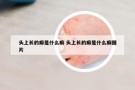頭上長的癬是什么癬 頭上長的癬是什么癬圖片