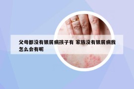 父母都沒有銀屑病孩子有 家族沒有銀屑病我怎么會有呢