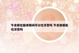 牛皮癬在服用期間可以吃洋蔥嗎 牛皮膚癬能吃洋蔥嗎