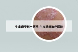 牛皮癬?？埔会t(yī)院 牛皮膚癬治療醫(yī)院