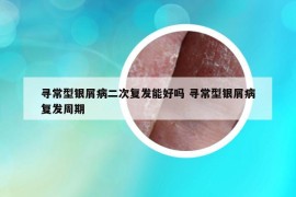尋常型銀屑病二次復(fù)發(fā)能好嗎 尋常型銀屑病復(fù)發(fā)周期