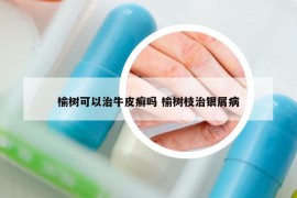 榆樹(shù)可以治牛皮癬嗎 榆樹(shù)枝治銀屑病
