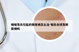 喉嚨發(fā)炎引起的銀屑病怎么治 咽炎會誘發(fā)銀屑病嗎