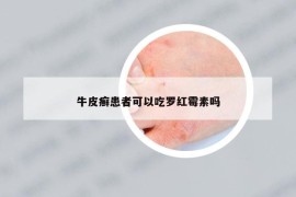 牛皮癬患者可以吃羅紅霉素嗎