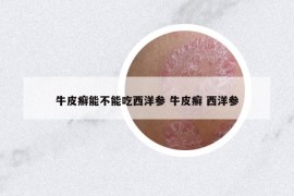 牛皮癬能不能吃西洋參 牛皮癬 西洋參