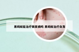 黑螞蟻能治療銀屑病嗎 黑螞蟻治療白發(fā)