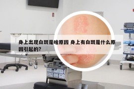 身上出現(xiàn)白斑是啥原因 身上有白斑是什么原因引起的?