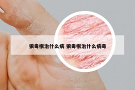 狼毒根治什么病 狼毒根治什么病毒