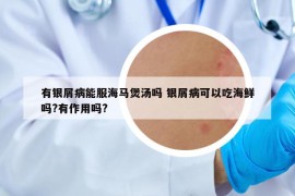 有銀屑病能服海馬煲湯嗎 銀屑病可以吃海鮮嗎?有作用嗎?