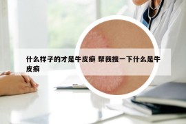 什么樣子的才是牛皮癬 幫我搜一下什么是牛皮癬