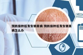 預(yù)防接種后發(fā)生銀屑病 預(yù)防接種后發(fā)生銀屑病怎么辦