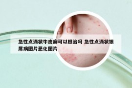 急性點(diǎn)滴狀牛皮癬可以根治嗎 急性點(diǎn)滴狀銀屑病圖片惡化圖片