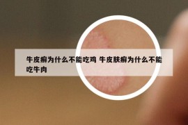牛皮癬為什么不能吃雞 牛皮膚癬為什么不能吃牛肉