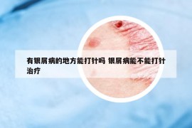 有銀屑病的地方能打針嗎 銀屑病能不能打針治療