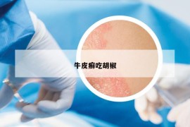 牛皮癬吃胡椒