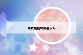 牛皮癬能喝熟姜水嗎