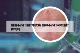 醋泡小蘇打治療牛皮癬 醋和小蘇打可以治療腳氣嗎