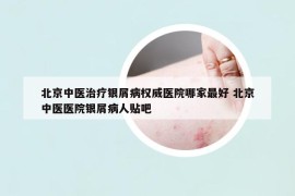 北京中醫(yī)治療銀屑病權(quán)威醫(yī)院哪家最好 北京中醫(yī)醫(yī)院銀屑病人貼吧