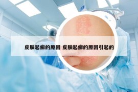 皮膚起癬的原因 皮膚起癬的原因引起的