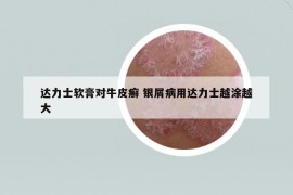 達力士軟膏對牛皮癬 銀屑病用達力士越涂越大
