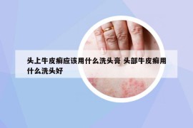 頭上牛皮癬應(yīng)該用什么洗頭膏 頭部牛皮癬用什么洗頭好