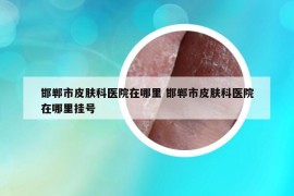 邯鄲市皮膚科醫(yī)院在哪里 邯鄲市皮膚科醫(yī)院在哪里掛號