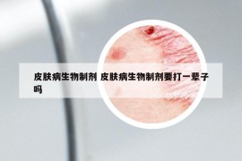 皮膚病生物制劑 皮膚病生物制劑要打一輩子嗎