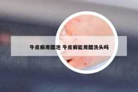 牛皮癬用醋泡 牛皮癬能用醋洗頭嗎