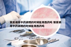 銀屑病用中藥調(diào)理的時候能用西藥嗎 銀屑病用中藥調(diào)理的時候能用西藥嗎
