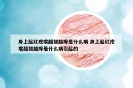 身上起紅疙瘩越撓越癢是什么病 身上起紅疙瘩越撓越癢是什么病引起的
