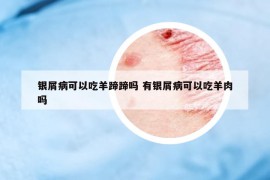 銀屑病可以吃羊蹄蹄嗎 有銀屑病可以吃羊肉嗎