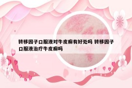 轉移因子口服液對牛皮癬有好處嗎 轉移因子口服液治療牛皮癬嗎