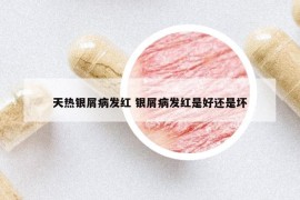 天熱銀屑病發(fā)紅 銀屑病發(fā)紅是好還是壞