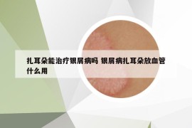 扎耳朵能治療銀屑病嗎 銀屑病扎耳朵放血管什么用