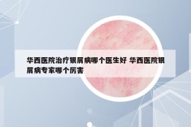 華西醫(yī)院治療銀屑病哪個醫(yī)生好 華西醫(yī)院銀屑病專家哪個厲害