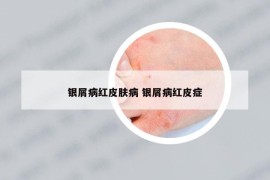 銀屑病紅皮膚病 銀屑病紅皮癥