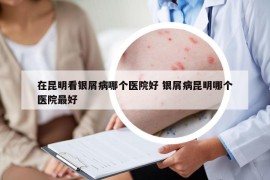 在昆明看銀屑病哪個醫(yī)院好 銀屑病昆明哪個醫(yī)院最好