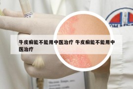 牛皮癬能不能用中醫(yī)治療 牛皮癬能不能用中醫(yī)治療