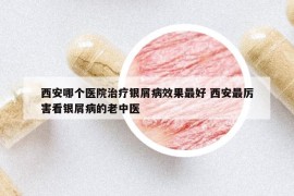 西安哪個(gè)醫(yī)院治療銀屑病效果最好 西安最厲害看銀屑病的老中醫(yī)