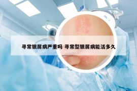 尋常銀屑病嚴(yán)重嗎 尋常型銀屑病能活多久