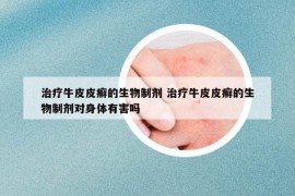 治療牛皮皮癬的生物制劑 治療牛皮皮癬的生物制劑對(duì)身體有害嗎