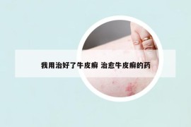 我用治好了牛皮癬 治愈牛皮癬的藥
