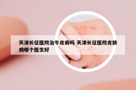 天津長(zhǎng)征醫(yī)院治牛皮癬嗎 天津長(zhǎng)征醫(yī)院皮膚病哪個(gè)醫(yī)生好