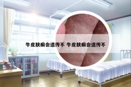 牛皮膚癬會遺傳不 牛皮膚癬會遺傳不