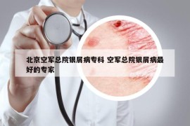 北京空軍總院銀屑病?？?空軍總院銀屑病最好的專家