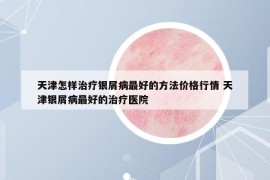 天津怎樣治療銀屑病最好的方法價(jià)格行情 天津銀屑病最好的治療醫(yī)院