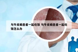 與牛皮癬患者一起吃飯 與牛皮癬患者一起吃飯怎么辦