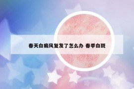 春天白癜風(fēng)復(fù)發(fā)了怎么辦 春季白斑