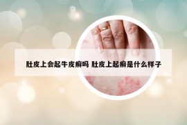 肚皮上會起牛皮癬嗎 肚皮上起癬是什么樣子
