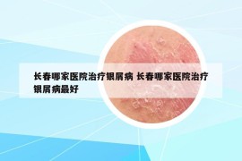 長春哪家醫(yī)院治療銀屑病 長春哪家醫(yī)院治療銀屑病最好